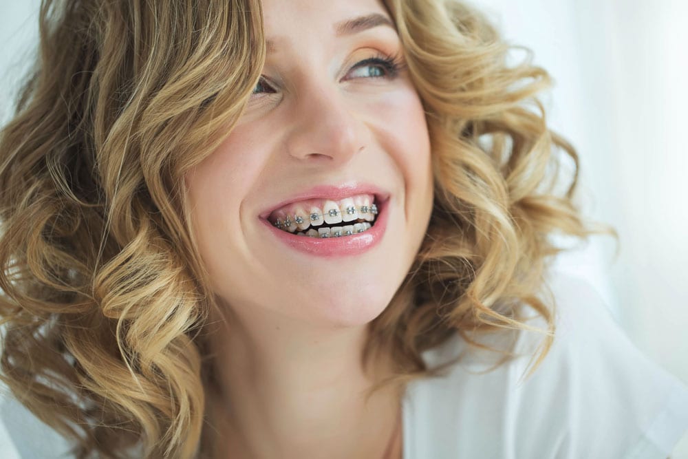 Braces-FAQ